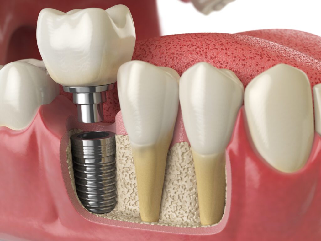 Dental Implants in Gettysburg, Pennsylvania