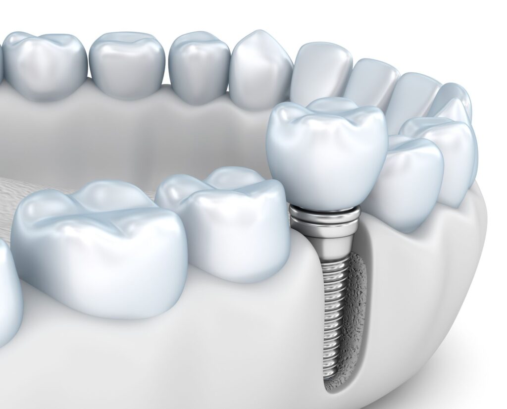 jawbone health with implant dentistry treatment