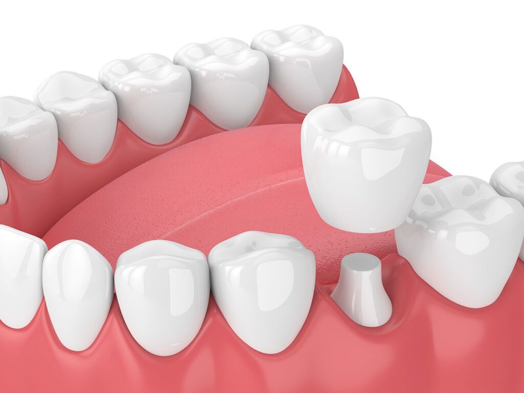 What Dental Crowns Can Treat in Gettysburg PA