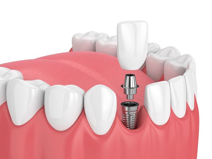 3 Types of Dental Implants