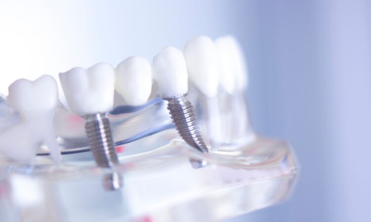 Understanding these options for a dental bridge can help you make an informed decision that suits your specific dental situation.