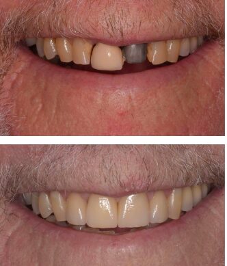 Before and After Getting a Single Dental Implant in Gettysburg PA