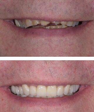 Full Mouth Rehabilitation in Gettysburg PA