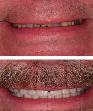 Before and After Veneers in Gettysburg PA