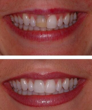 Teeth Whitening Treatment Gettysburg PA