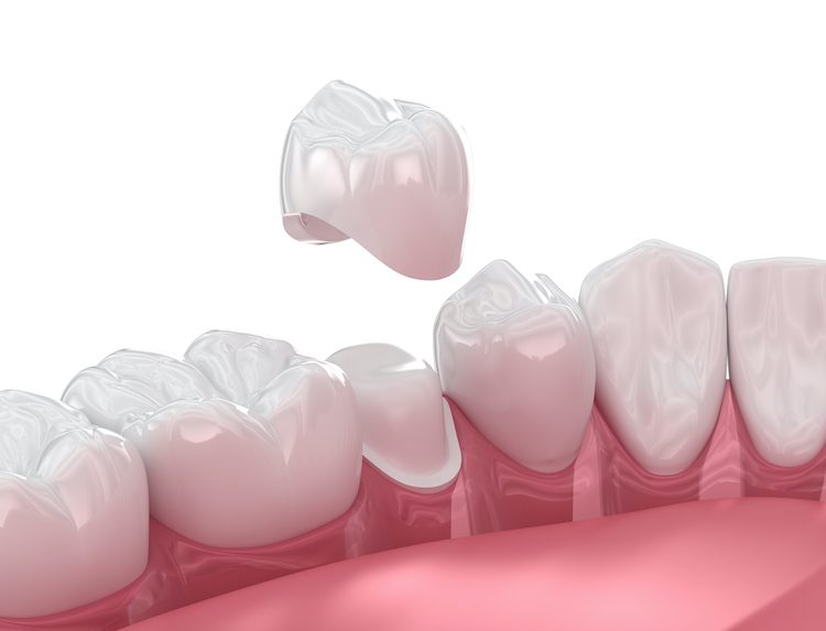 While the idea of getting a dental crown may sound intimidating, understanding each step can help ease anxiety and prepare you.