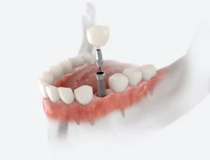 Dental Implants vs. Bridges in Gettysburg, PA